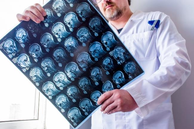 רופא נוירואימונולוג בוחן בדיקת הדמיה לאבחון של מחלה נוירו אימונולוגית כמו טרשת נפוצה